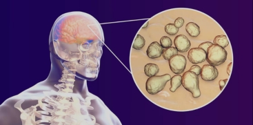 Amoebic Encephalitis 