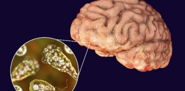 Amoebic Meningoencephalitis