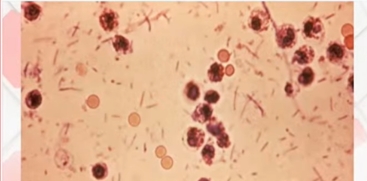 Shigella Confirmed in Kollam