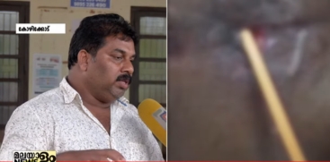 Inquiry Ordered at Kozhikode Medical College After Patient's Death Following Alleged Surgical Error