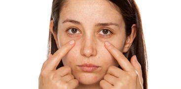Dark circles under the eyes are also a symptom of many health problems 