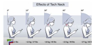 What is Tech Neck? Know the symptoms and prevention