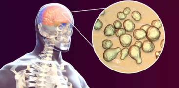  Amoebic Meningoencephalitis