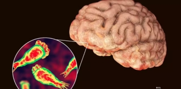 Amoebic Meningoencephalitis Death