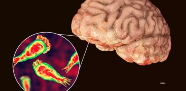 Amoebic Meningoencephalitis Confirmed in 2 More Children in State