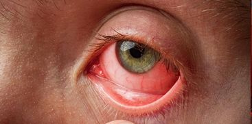 Pink eye (conjunctivitis) - Symptoms and causes
