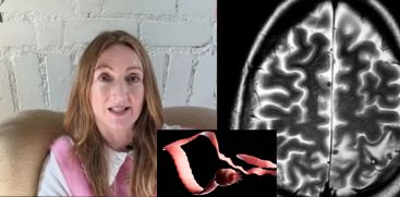 Neurocysticercosis