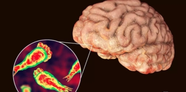 11-Year-Old Girl in Kozhikode Recovers from Brain-Eating Amoeba Infection