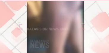 Disabled Person Allegedly Assaulted in Kozhikode Over Theft Accusation