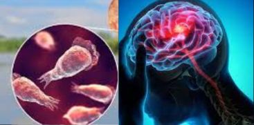AMOEBIC MENINGOENCEPHALITIES