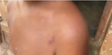 4-Year-Old Girl Injured Due to Extreme Heat