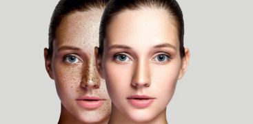 How to Remove Dark Spots on the Face